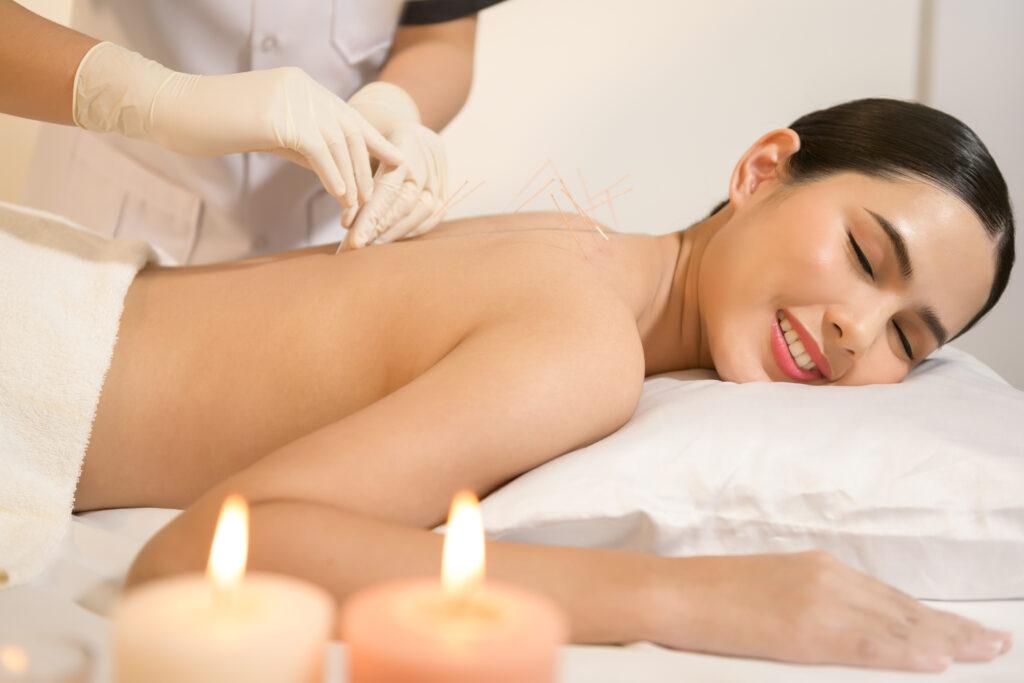 Mulher jovem recebendo acupuntura